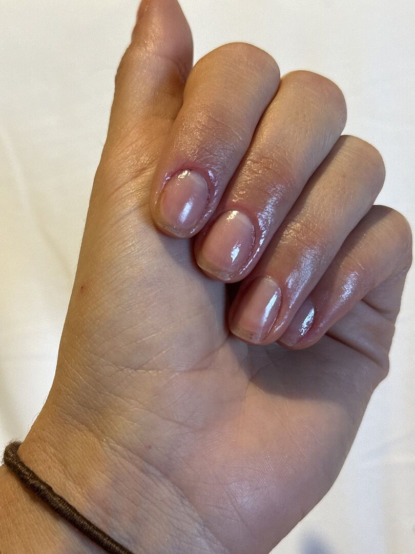 Rettung nach Acryl