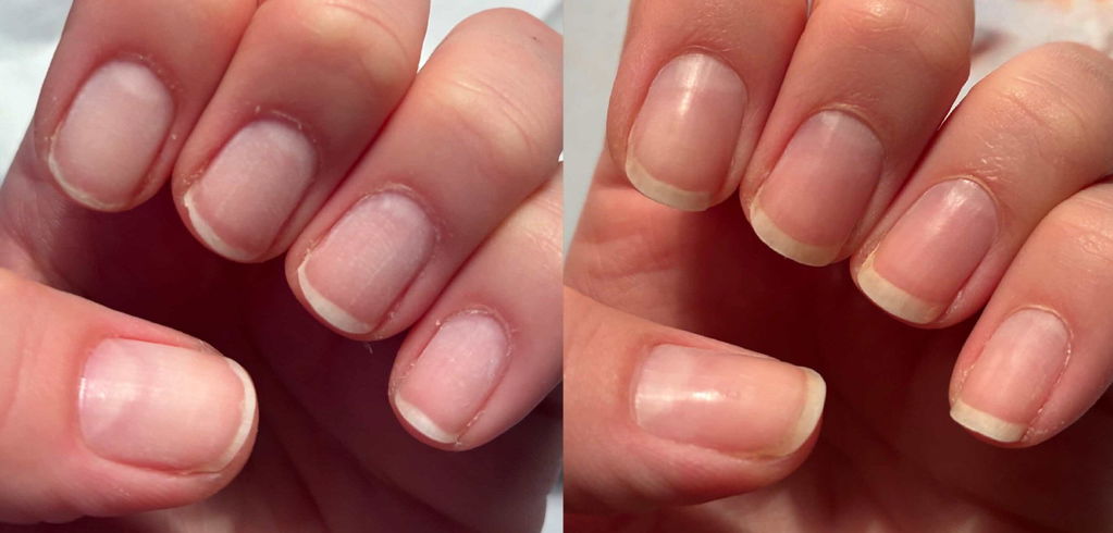 Rettet meine Nagelhaut