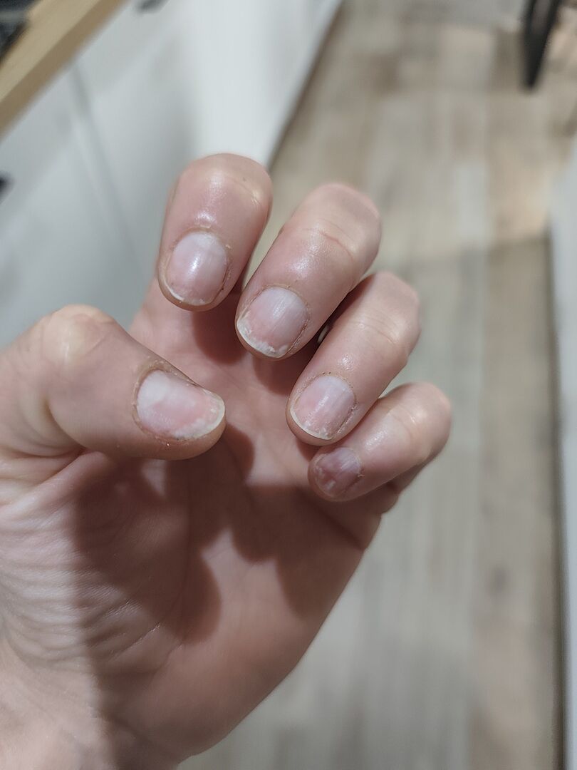 Rettung nach Gel-Schaden